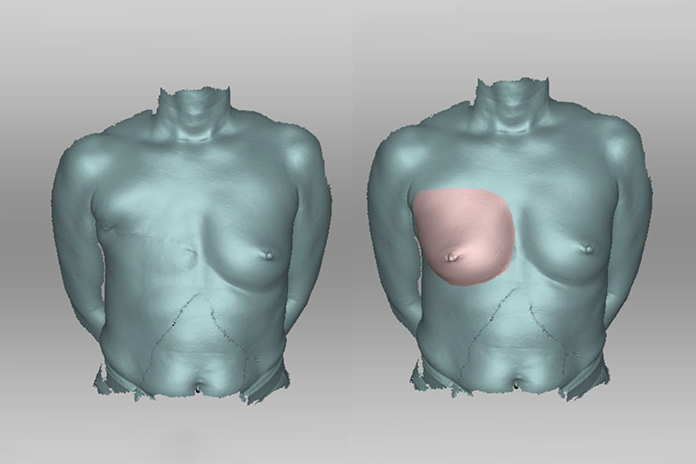 breast-prosthetics-02.jpg