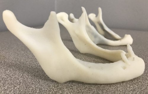 Des chirurgiens exploitent l’impression 3D lors de chirurgies mandibulaires 