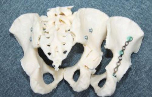 Des modèles 3D améliorent les chirurgies orthopédiques au sein d’un hôpital 