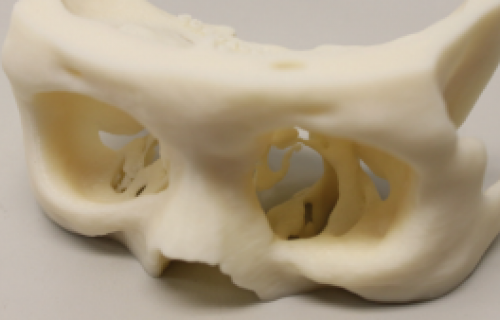 L'imprimante 3D Fortus permet de réaliser des moules d'implants orbitaux 