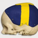 Le CTI Renato Archer imprime en 3D des prototypes du crâne d’une victime d’accident 