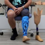 Création d'une prothèse unique en son genre avec Artec Eva et Geomagic Freeform