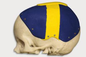 Le CTI Renato Archer imprime en 3D des prototypes du crâne d’une victime d’accident
