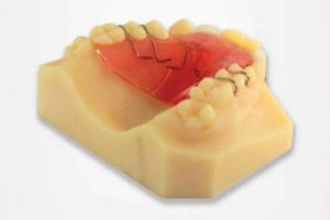 L'impression 3D révolutionne l'orthodontie numérique