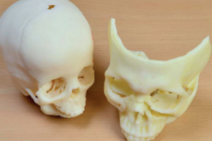 Les crânes des patients sont imprimés en 3D en quelques heures