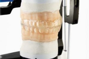 L'impression 3D révolutionne l'orthodontie numérique