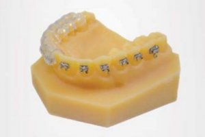 L'impression 3D révolutionne l'orthodontie numérique