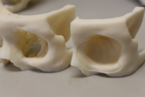 L'imprimante 3D Fortus permet de réaliser des moules d'implants orbitaux